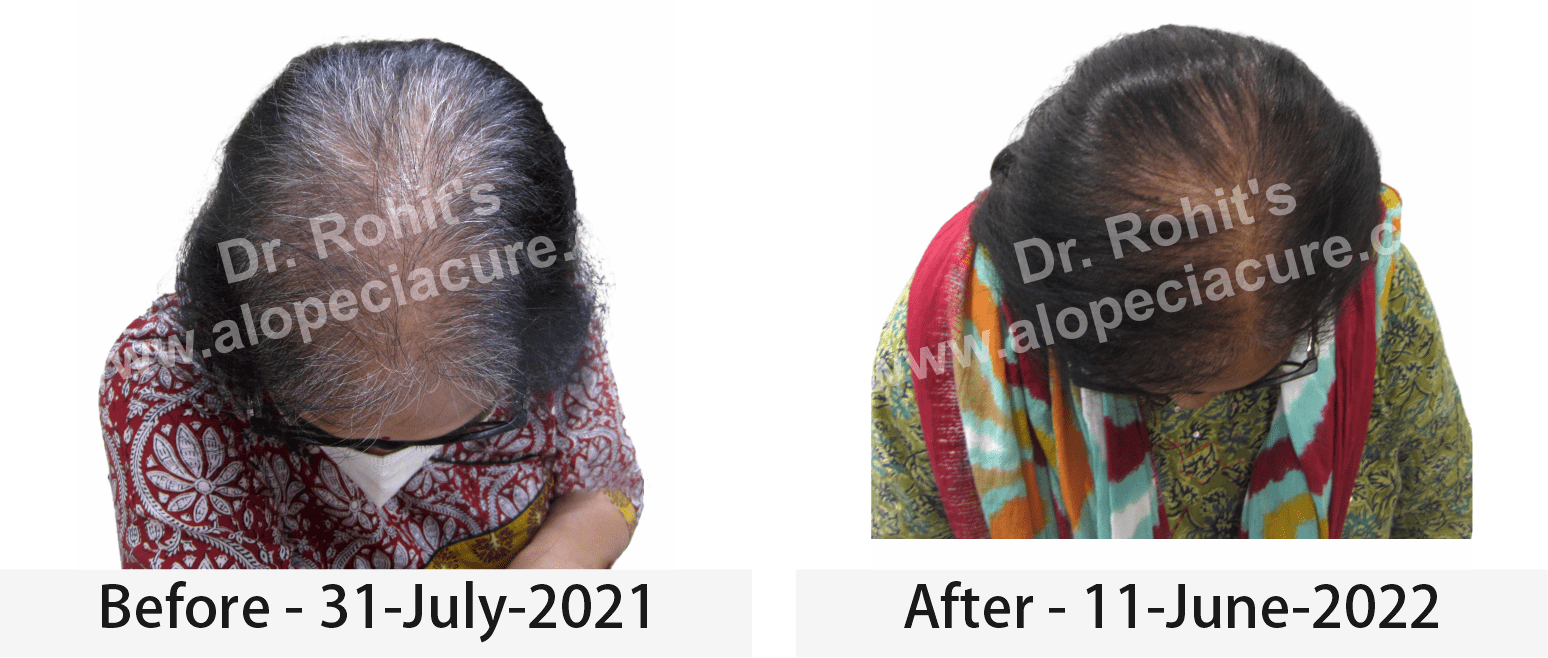 hair loss treatment